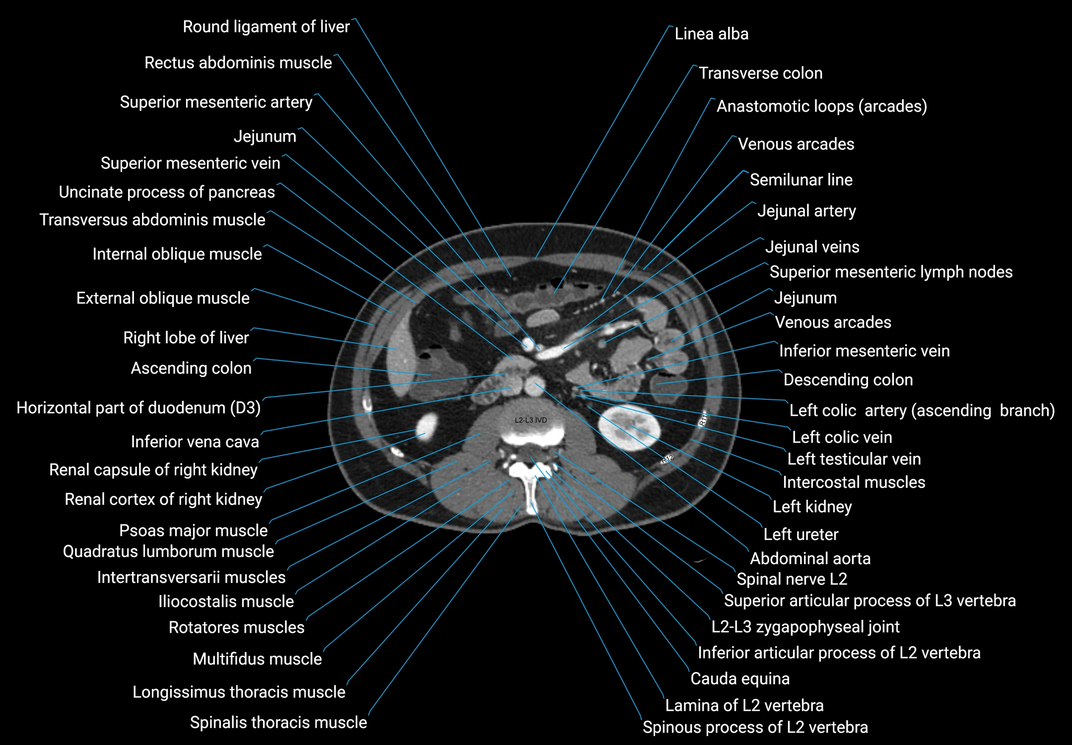 CT male pelvis axial cross sectional anatomy labelled radiology image -00081.webp